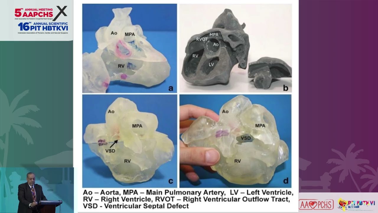 DORV with Non-committed VSD : Biventricle or Single Ventricle Repair - Zohair Al Halees