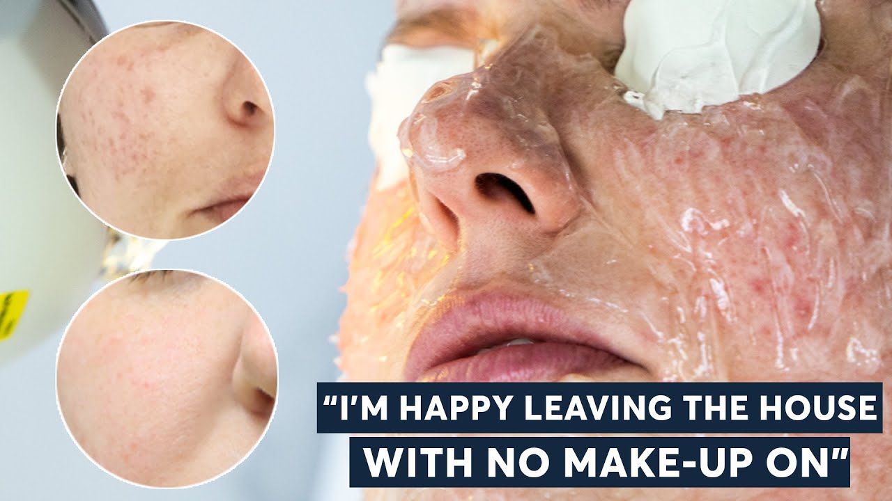 5 Foods That Triggered My Rosacea | London