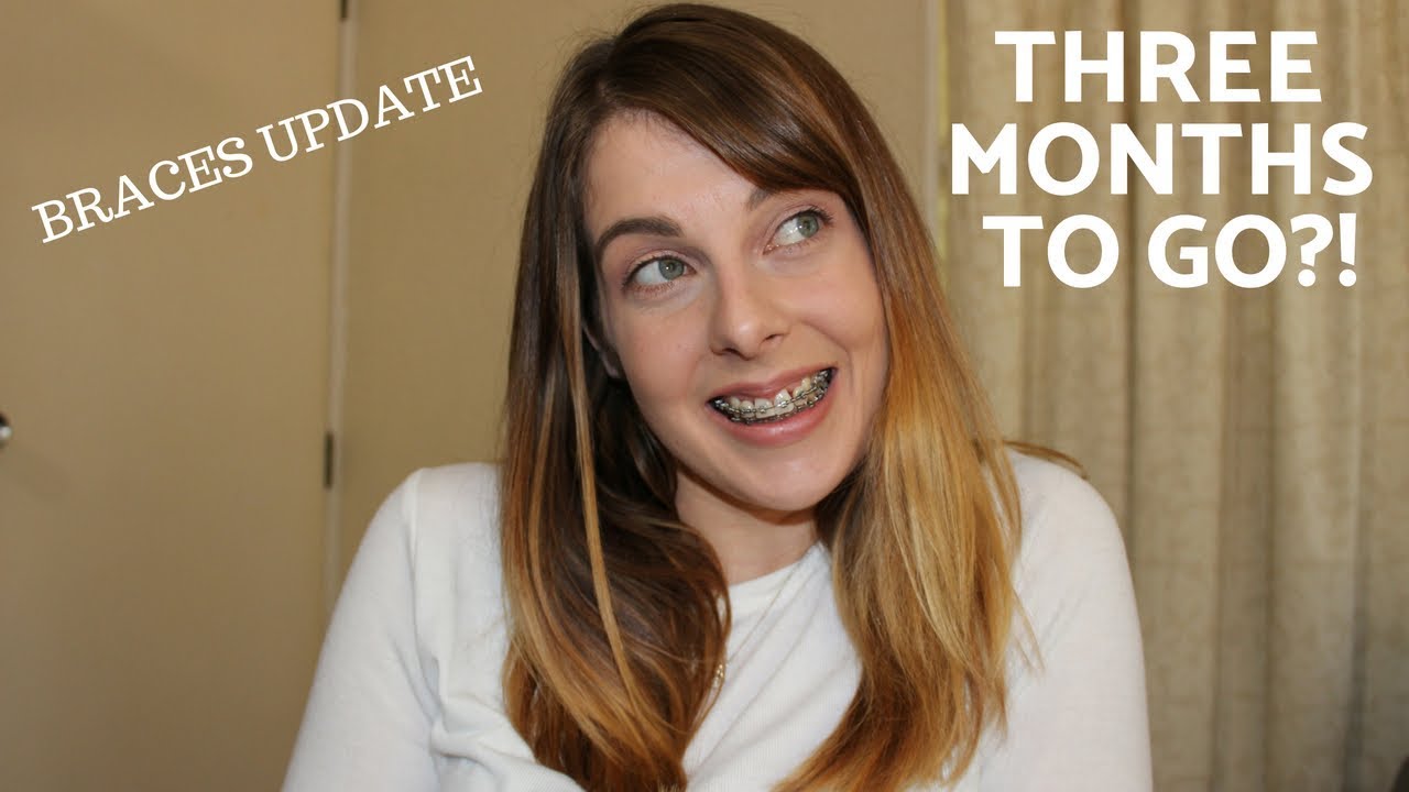 Adult Braces Update | 3 Months To Go?