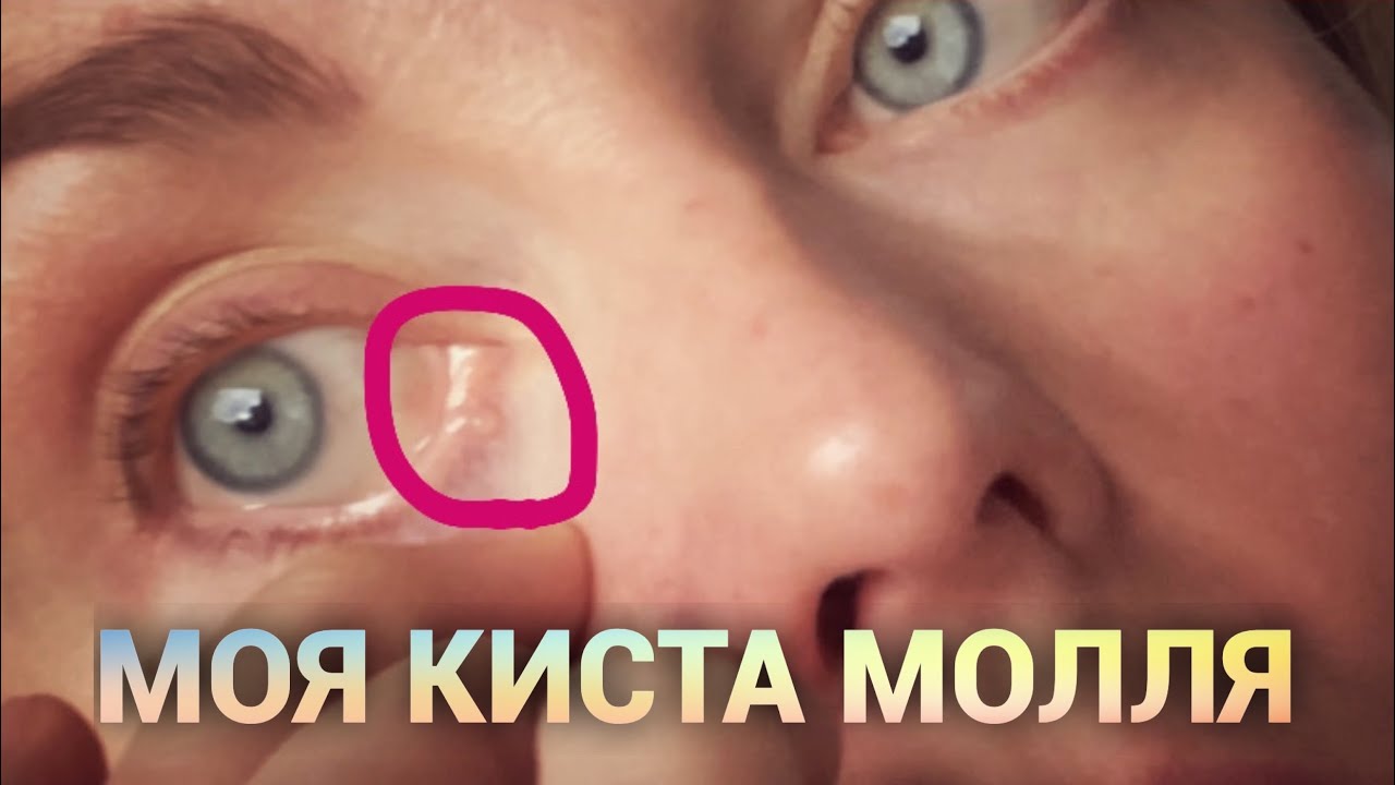 Моя киста Молля. Отправили на операцию. Часть 1. Просто дневник Константиновой.