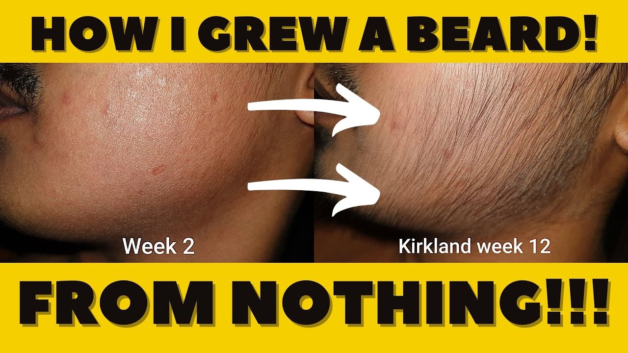 Growing a QUARANTINE BEARD even WITHOUT BEARD GENES! | Asian Minoxodil journey 3 month progress!