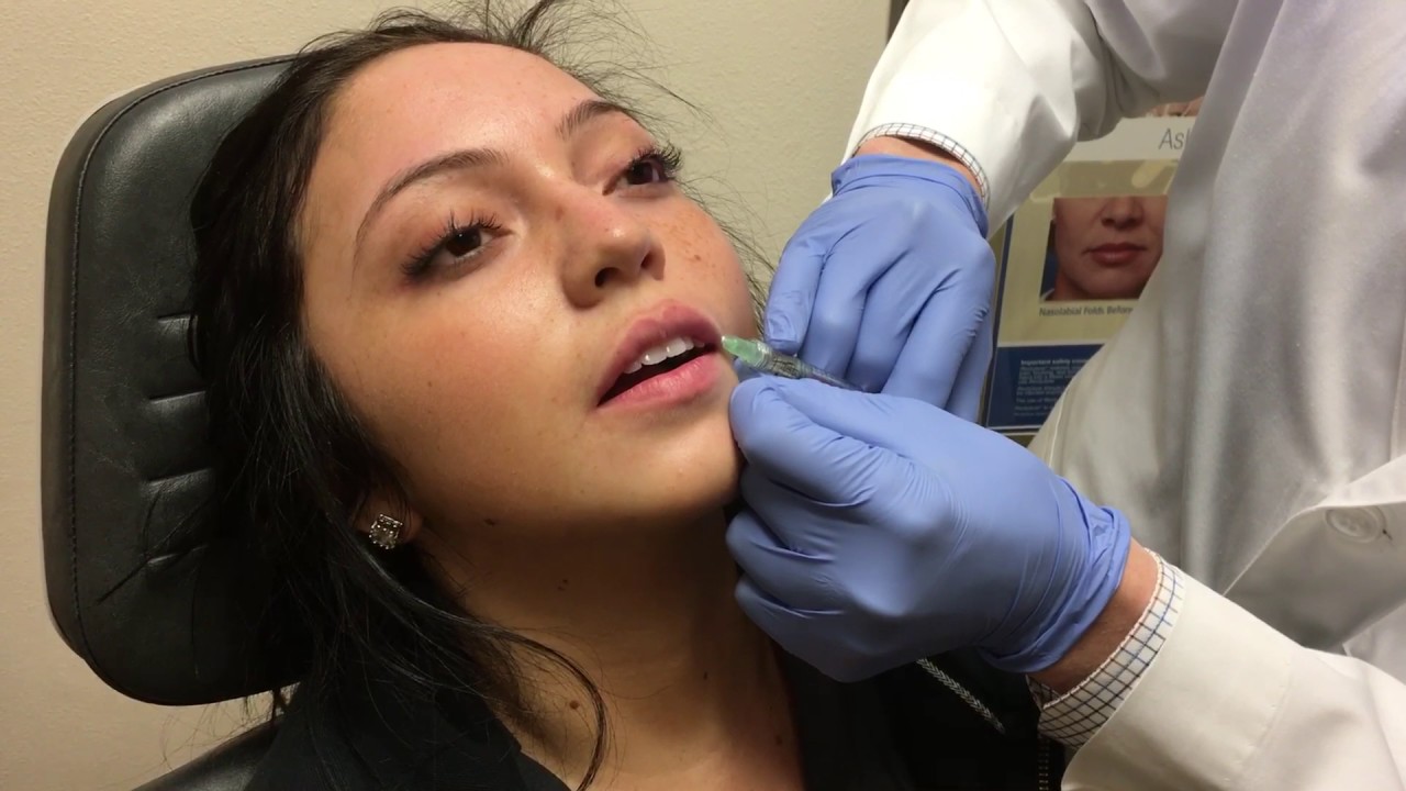 Lip augmentation with Juvederm Volbella