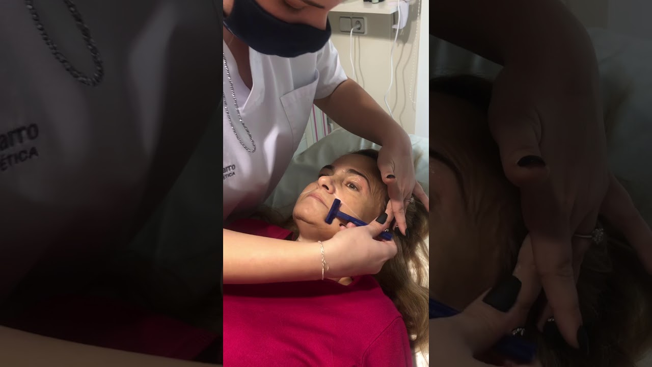 Depilación láser diodo Facial