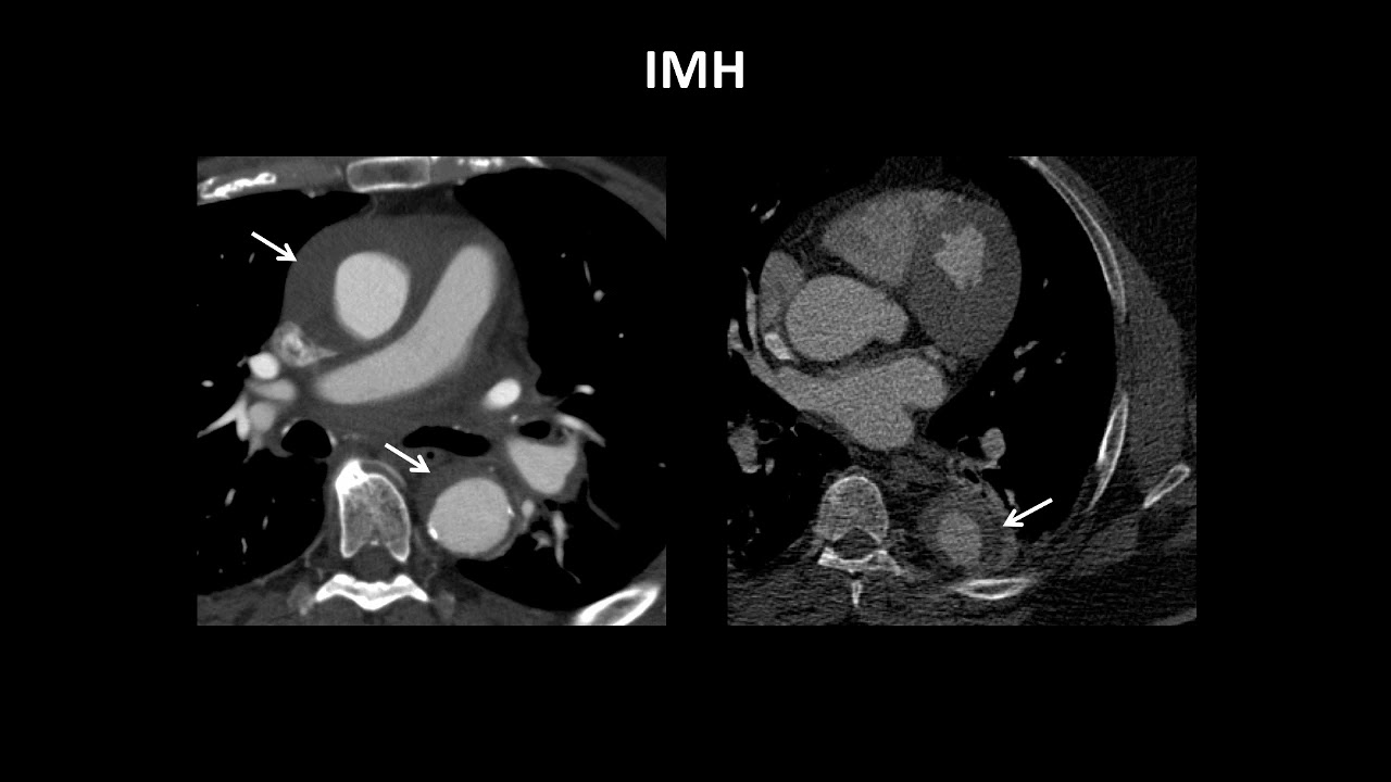 MultiModality Imaging of Acute Aortic Syndromes