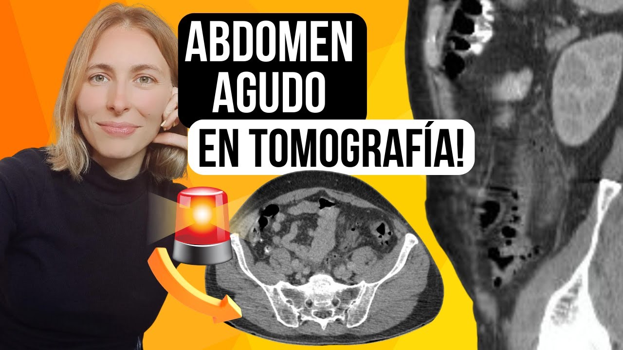 Abdomen agudo en tomografía: Guía práctica y hallazgos clave ✅