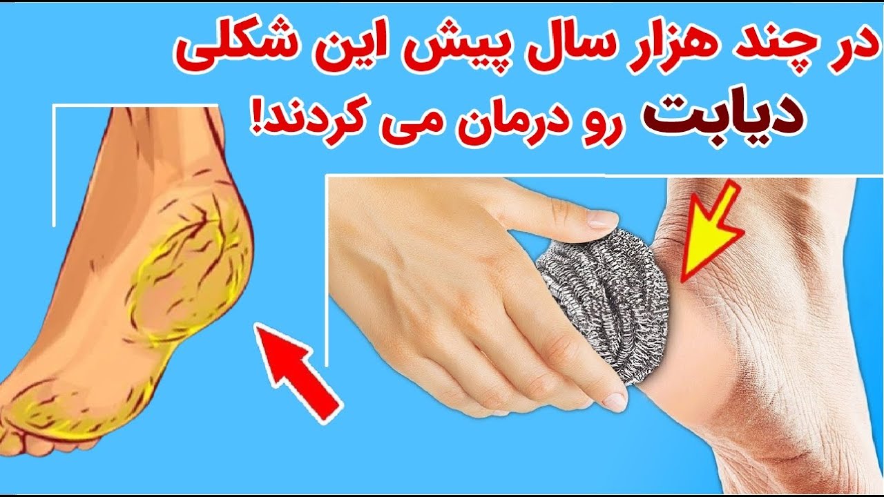 در قدیم چگونه دیابت رو کنترل و درمان میکردند!