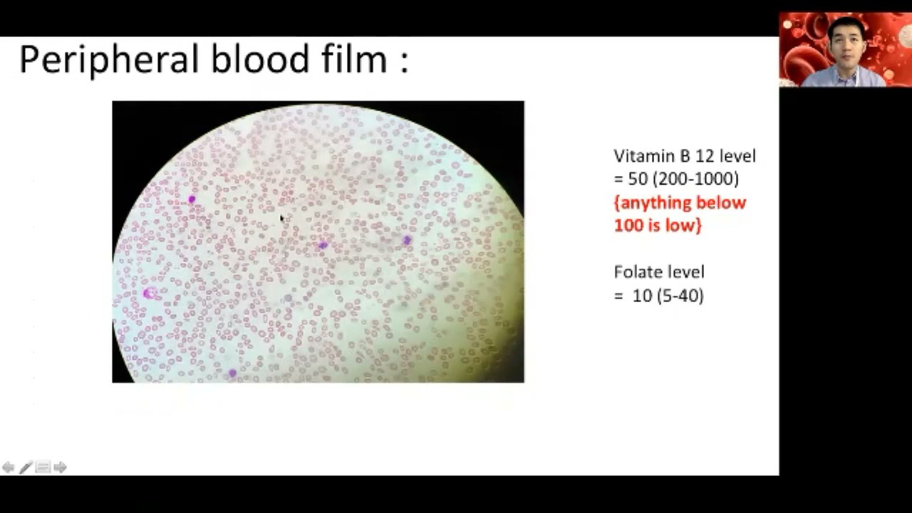 Haematology Week 1 - Approach to Pancytopenia