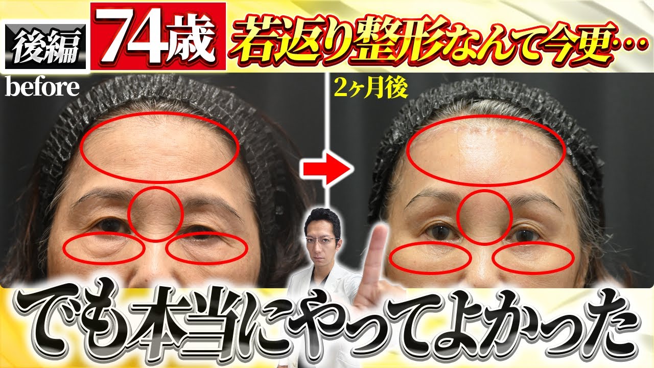【後編】LVS切開による若返り手術｜W切開による劇的リフトアップの症例を徹底解説