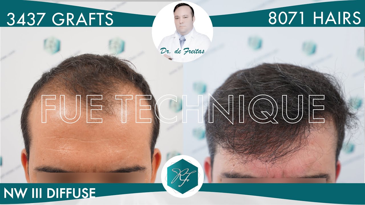 Hair Graft Technique FUE - 3437 Grafts (8071 Hairs)