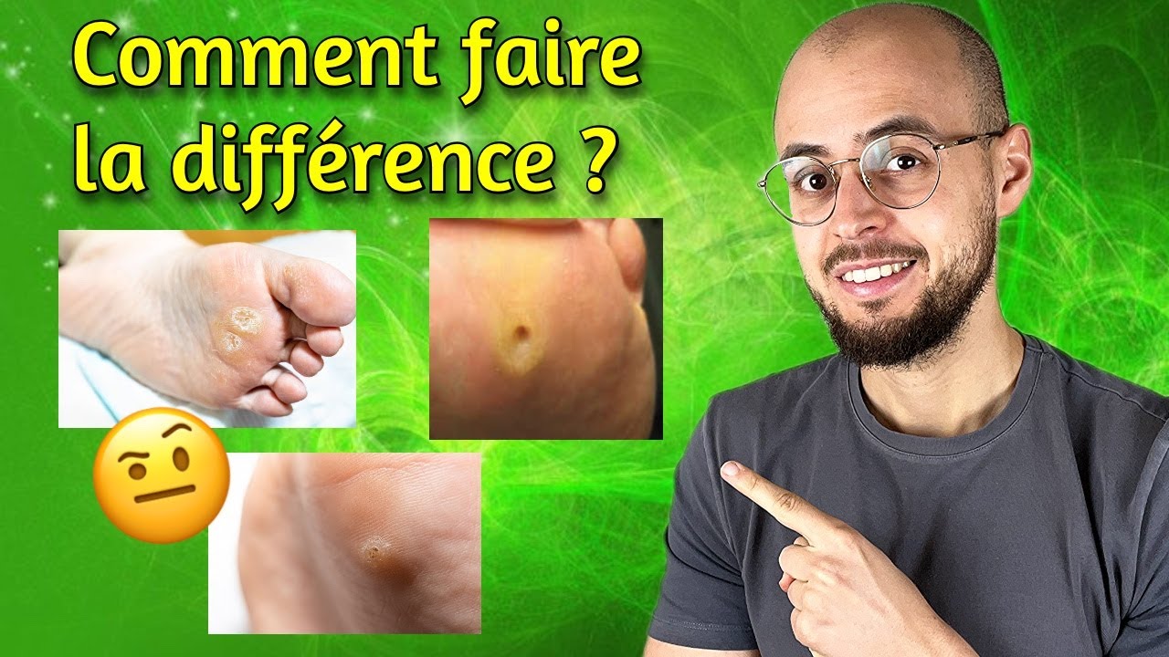 Cor VS Durillon VS Verrue au pied : Comment les reconnaitre ?