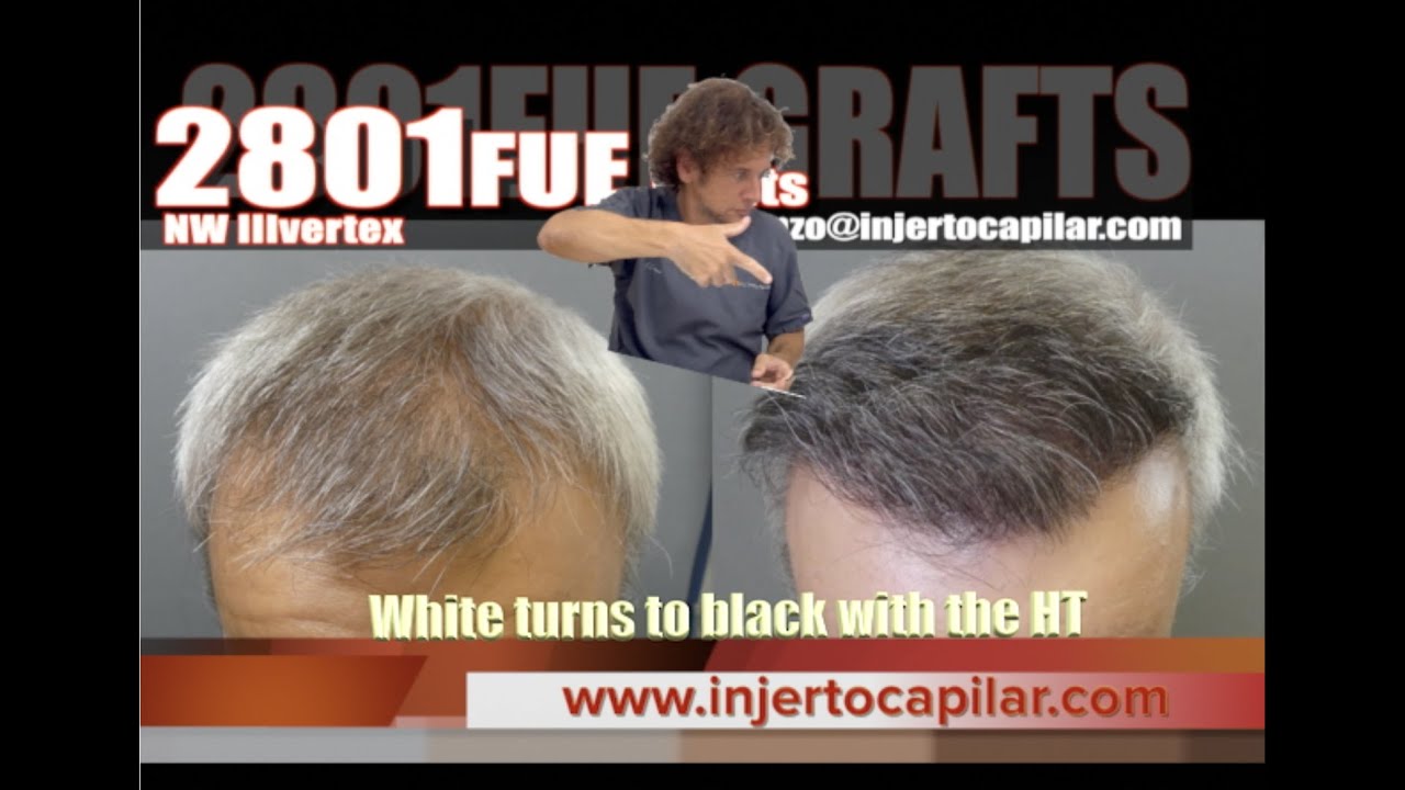 2801FUE Grafts. III vertex. White turn to black with hair transplant. Injertocapilar.com.2677/2021