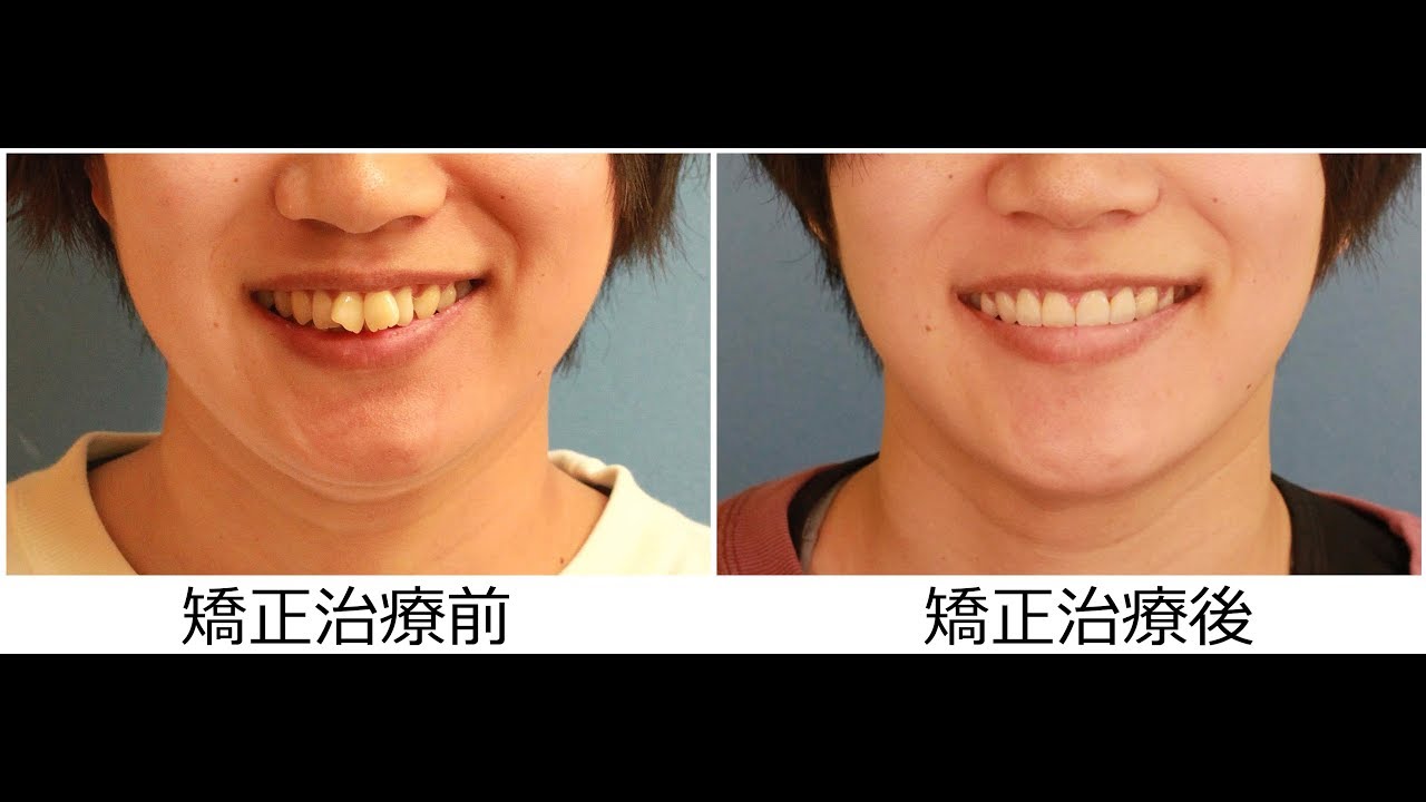 27歳 女性 「 ねじれ歯、出っ歯を治したい 」 治療期間15か月（ 翼状捻転 ）