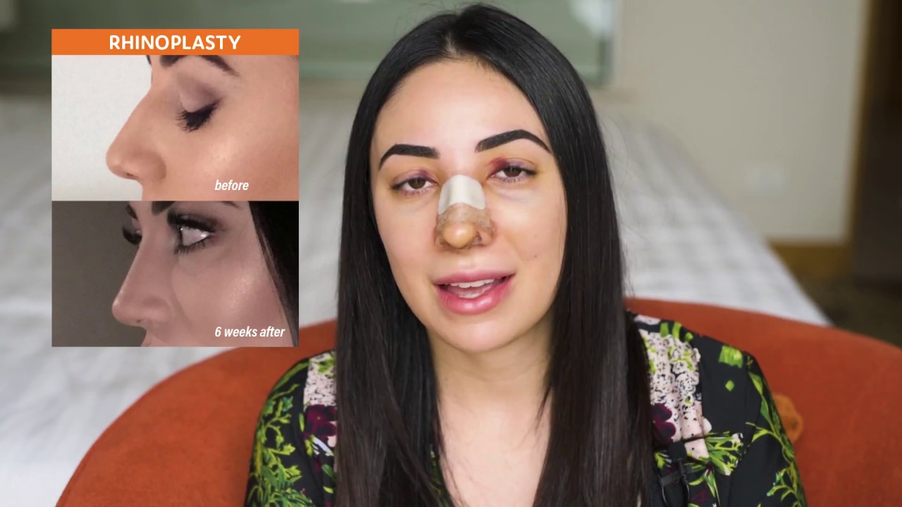 Christina Shares her Pre & Post Rhinoplasty Experience in Bangkok