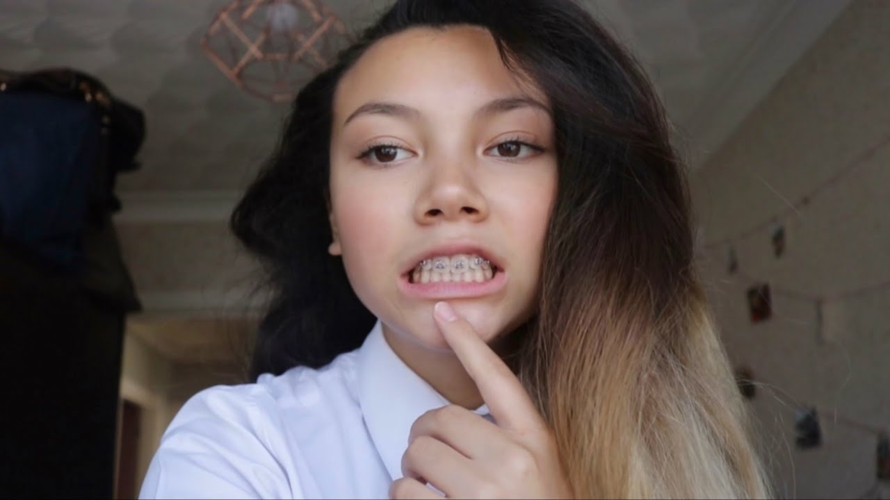 GETTING BRACES FOR THE FIRST TIME VLOG