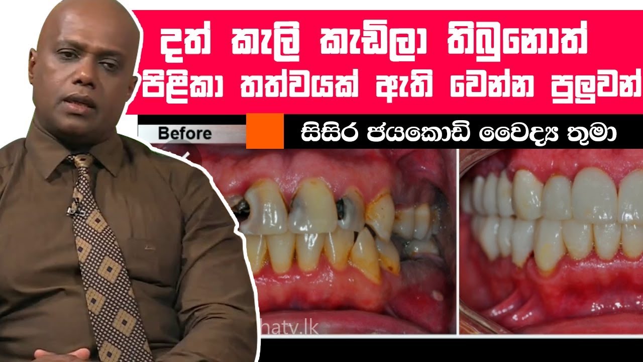 දත් කැලි කැඩිලා තිබුනොත් පිළිකා තත්වයක් ඇති වෙන්න  | Piyum Vila | 18-06-2019 | Siyatha TV