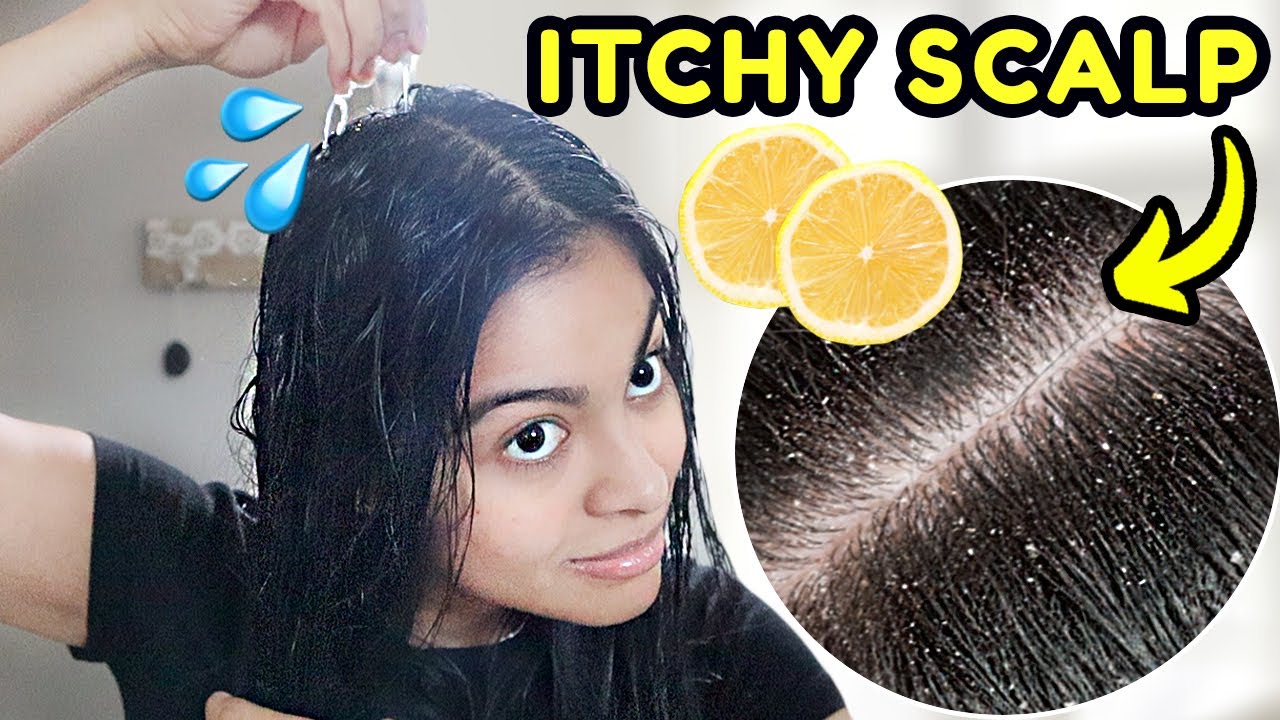 How I GET RID OF DANDRUFF in one hair wash! *lemon juice treatment*