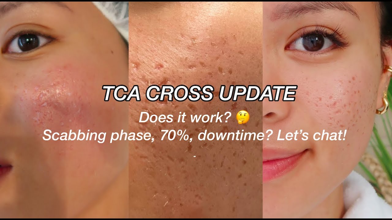 ОБНОВЛЕНИЕ TCA CROSS l ШРАМЫ ОТ АКНЕ