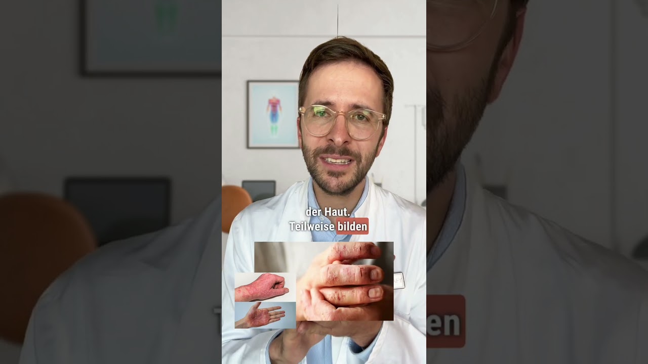 So sieht ein Handekzem aus! | DERMAFY #shorts