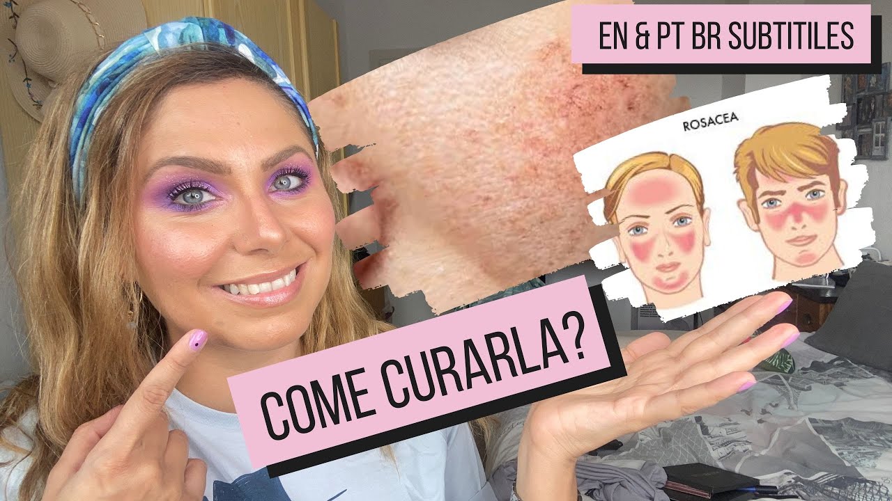 Rosacea: cos'è e come curarla con la skincare | Skin Edit