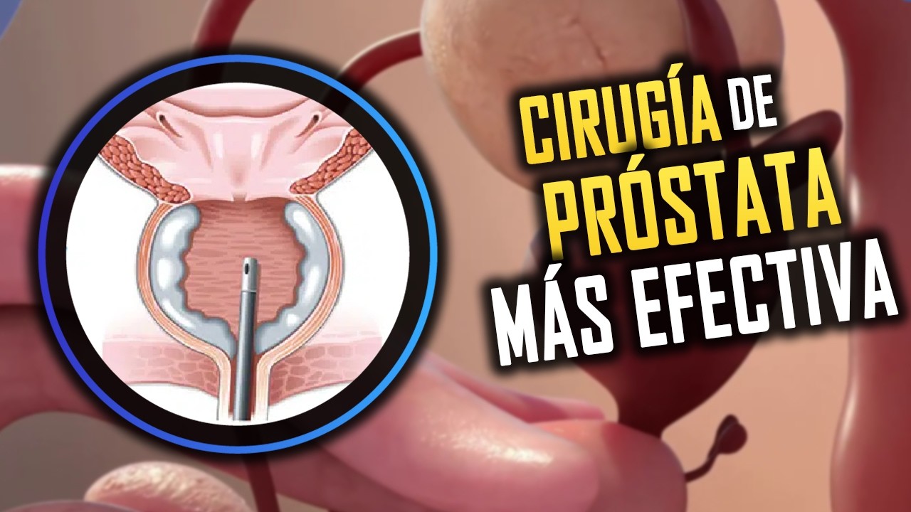 La Cirugía que Tiene los Mejores Resultados para la Próstata Agrandada (HoLEP)