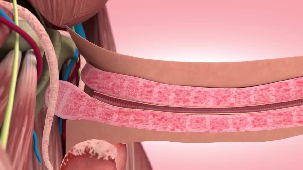 Activation Clinic Offers Breakthrough Treatment for Peyronie&rsquo;s Disease