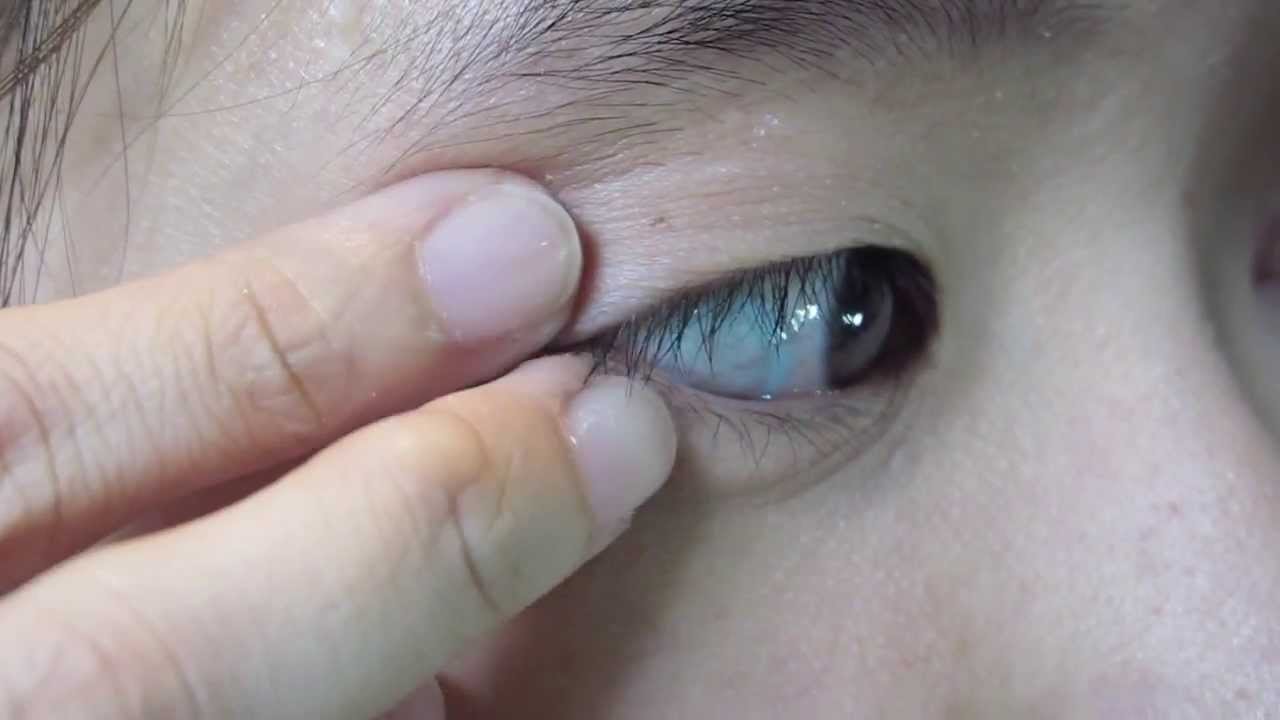 CLURU : How to insert and remove RGP lens. การใส่ถอดคอนแทคเลนส์กึ่งนิ่มกึ่งแข็ง