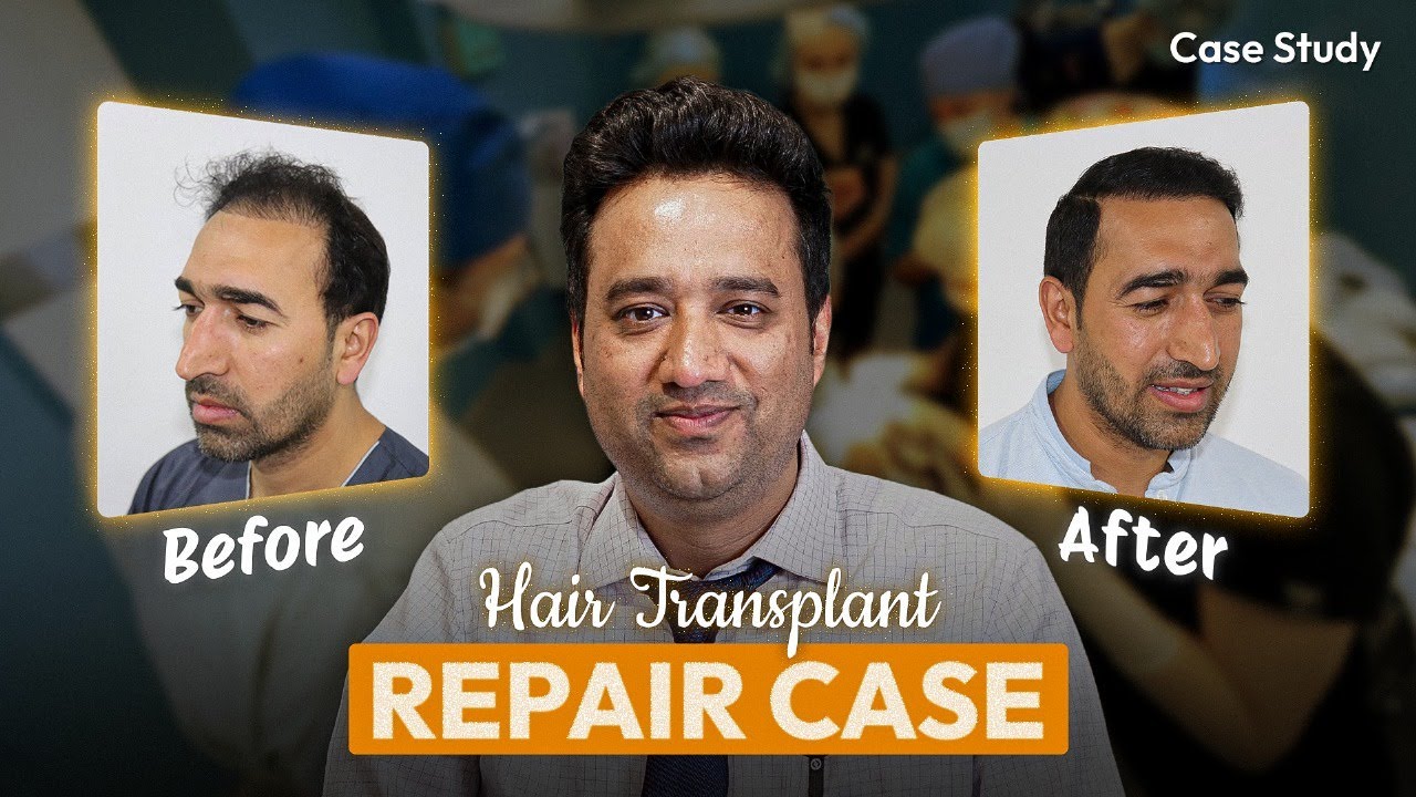 How Dr. Pramod Agrawal Repaired a Failed Hair Transplant - CASE STUDY