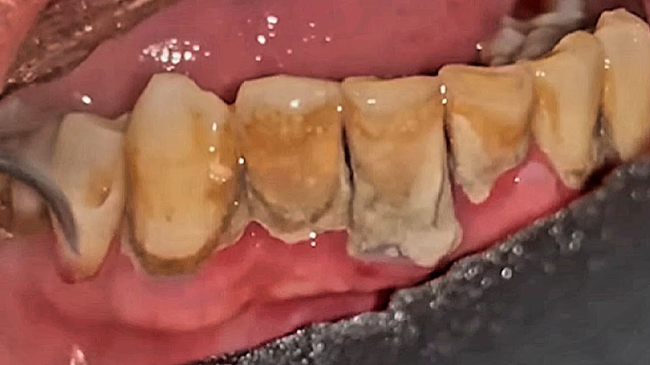 Tartar Removal Before and After - Satisfying video #013