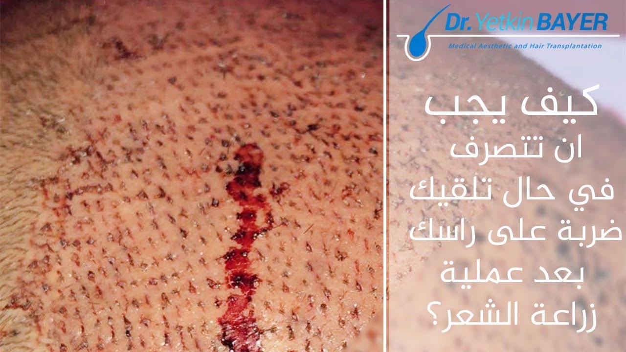 بعد زراعة الشعر - دكتور يتكين باير - Dr Yetkin Bayer -