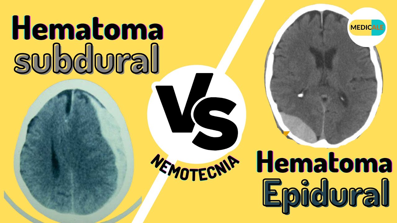 Diferencias entre HEMATOMA SUBDURAL Y EPIDURAL - NEMOTECNIA