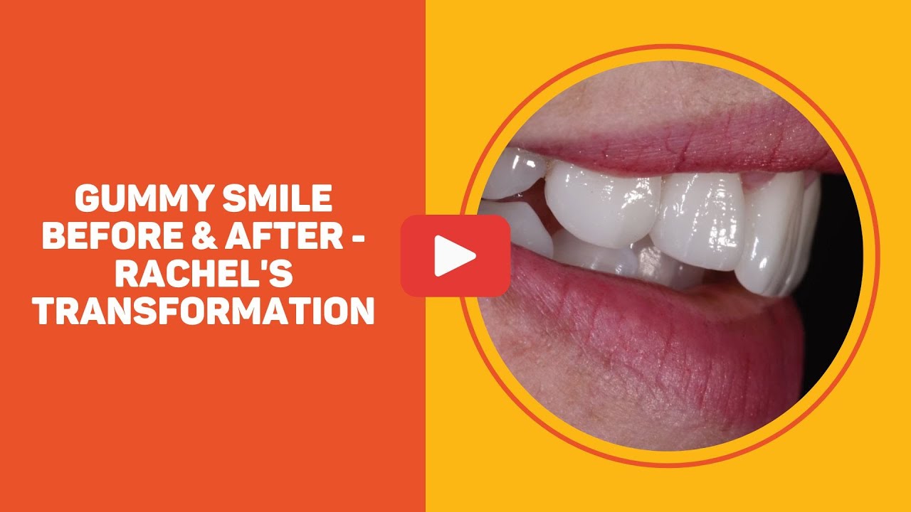 Gummy Smile Before & After - Rachel's Transformation