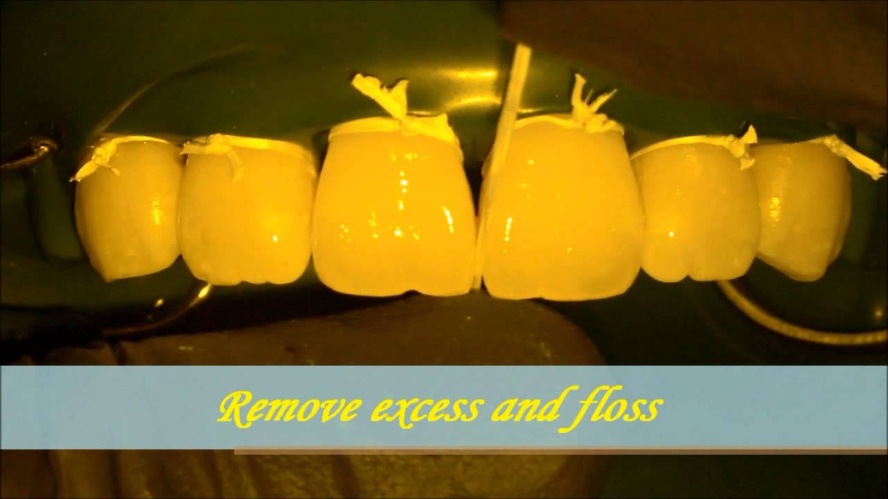 Infiltrant Resin Treatment of White Spot lesions