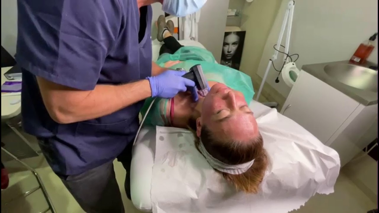 Sesión de tratamiento con Morpheus8 para rejuvenecimiento facial