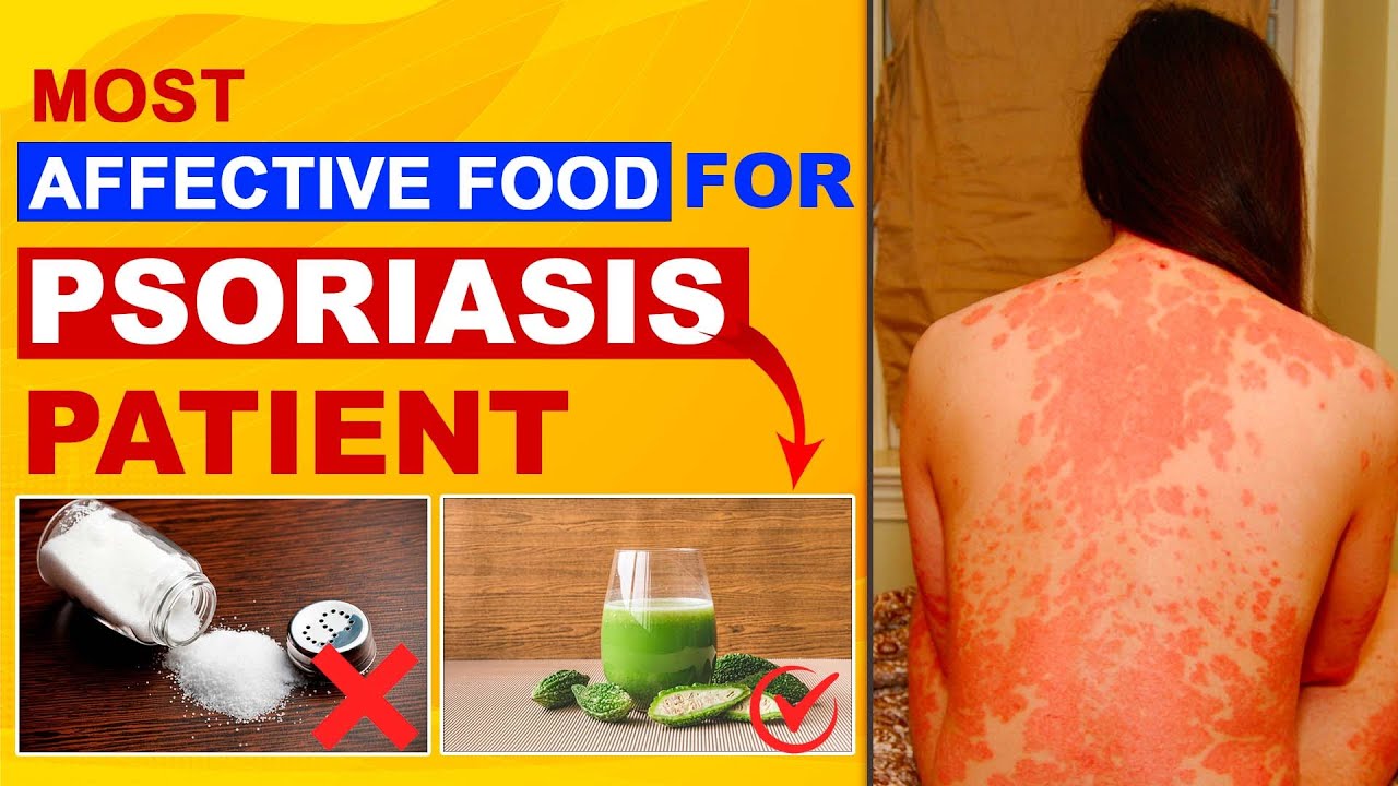 Food To Eat & Food To Avoid in Psoriasis | Best Way To Reduce Psoriasis | Dr. Health