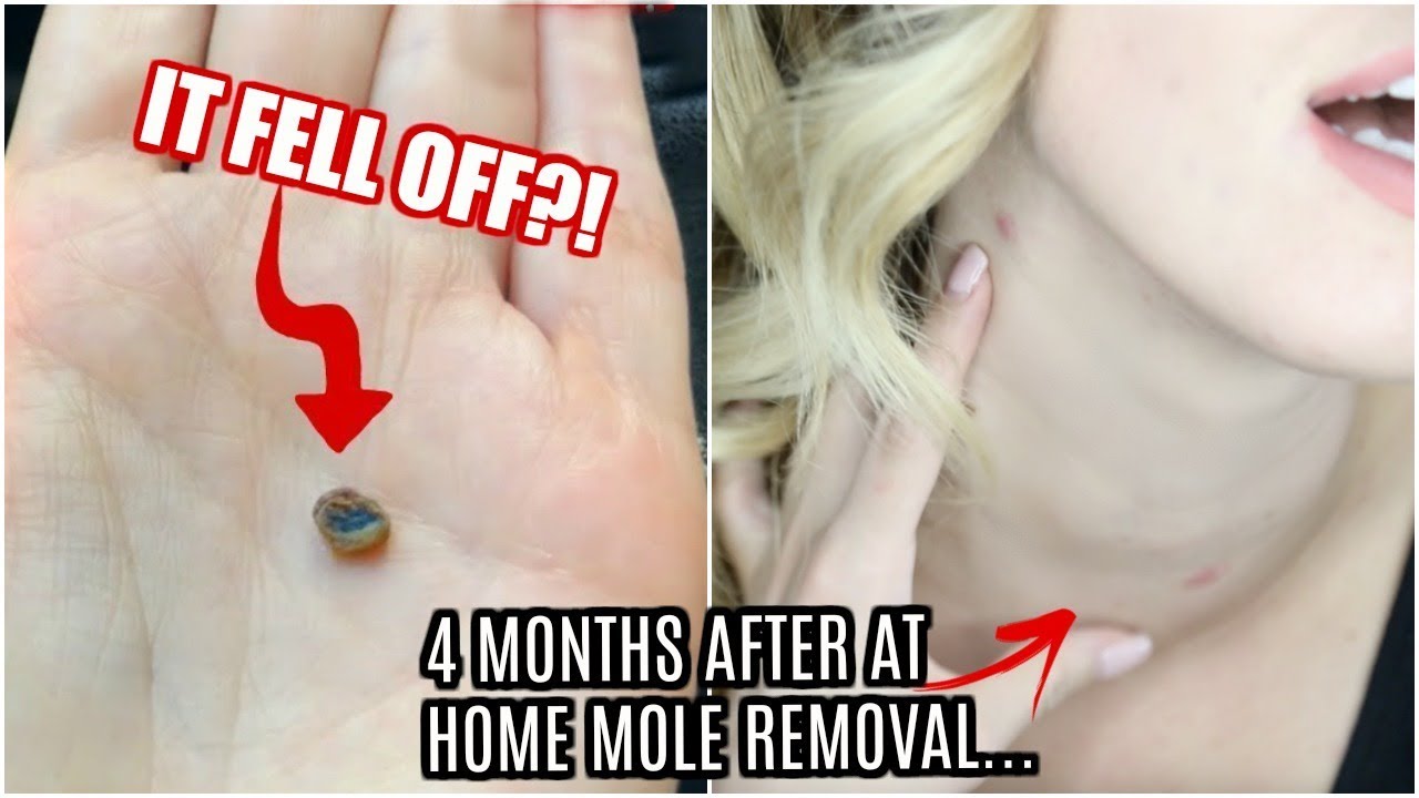 AT HOME MOLE REMOVAL 4 MONTHS LATER!