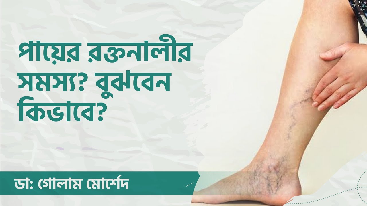 পায়ের রক্তনালী ব্লক হলে করনীয় কি?  by Dr. Golam Morshed FCPS, MRCP UK. Medicine & Heart Specialist