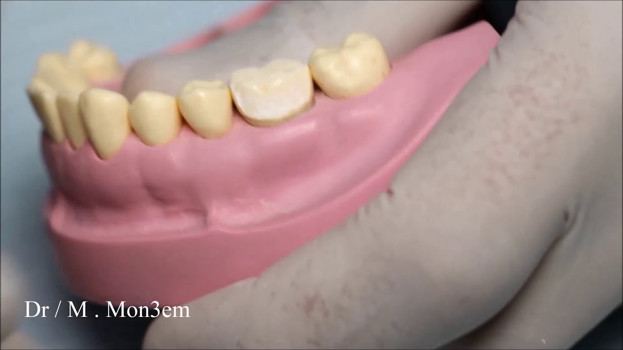 Full Veneer metal crown prep