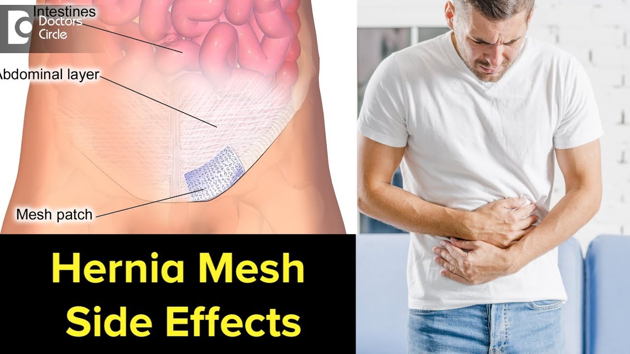 Can Hernia mesh cause problems years later? Signs, Symptoms, Treatment - Dr. Nanda Rajaneesh
