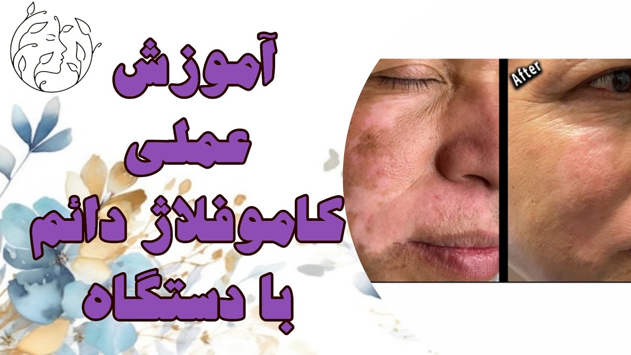 آموزش عملی کاموفلاژ دائم با دستگاه | آموزش کاموفلاژ دائم برای درمان جای اسکار لک | کاموفلاژ ویتیلیگو
