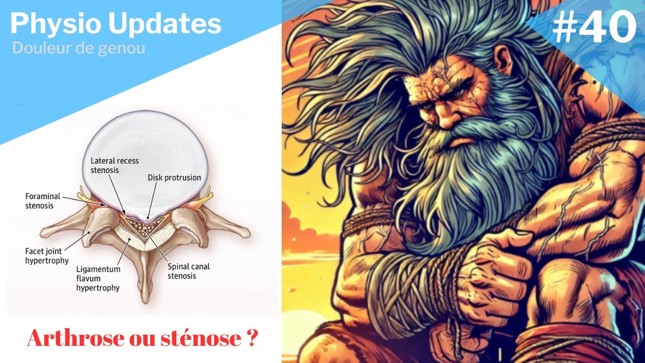 Comprendre les douleurs de genou (arthrose de genou ou sténose lombaire ?)
