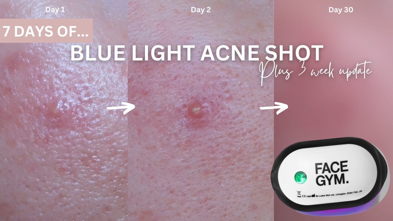 7 Days of Facegym Blue Light for Acne PLUS 3 WEEK UPDATE