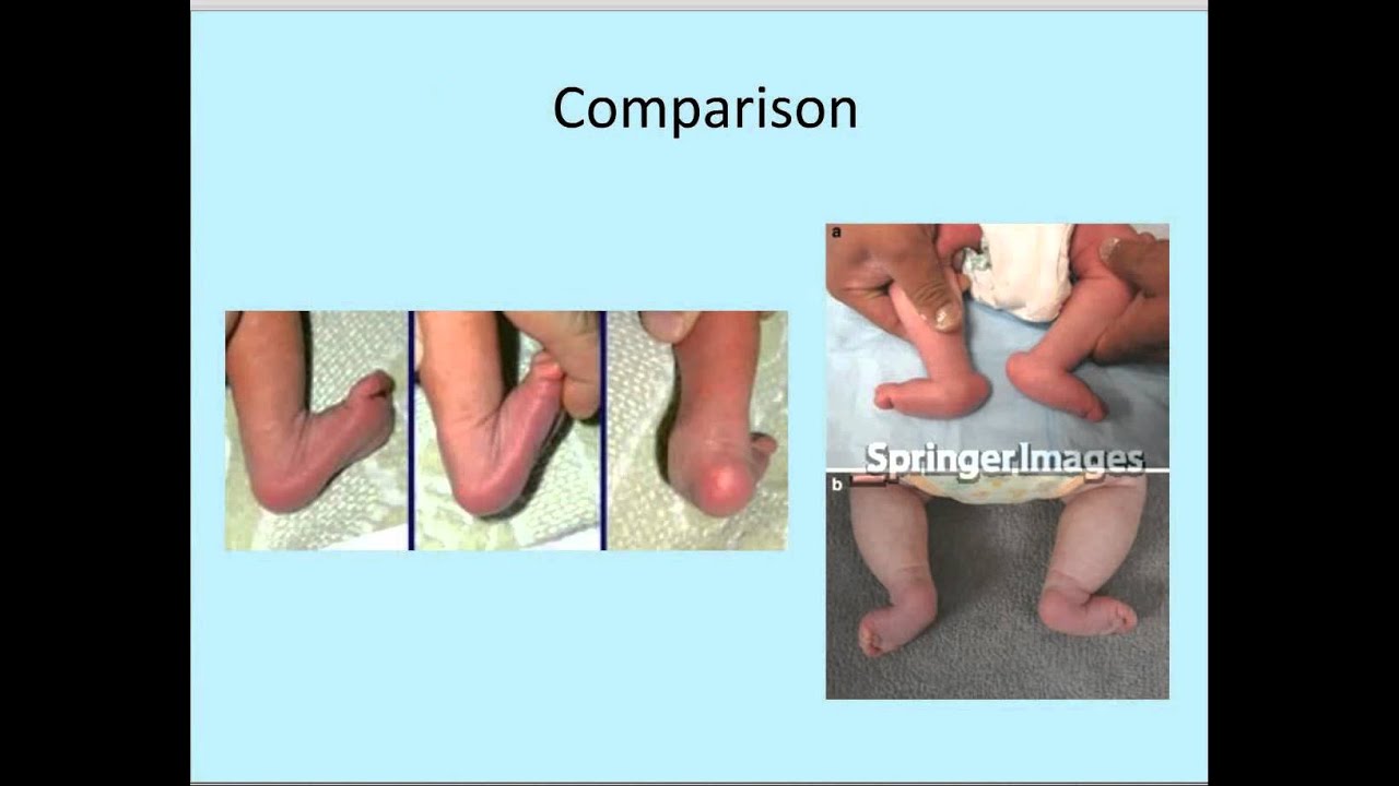 Congenital Vertical Talus