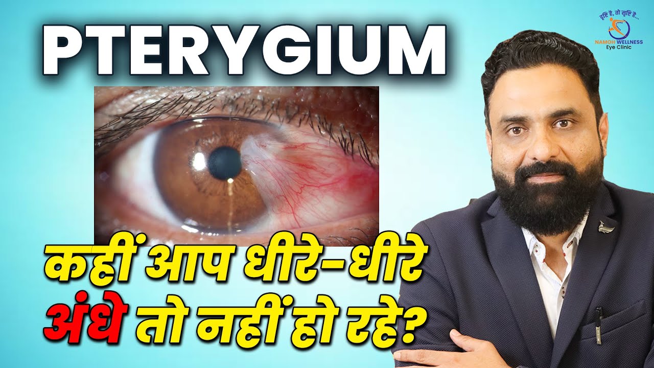 Pterygium – Causes, Symptoms & Treatment | Eye Health Awareness by Dr. S.S. Verma