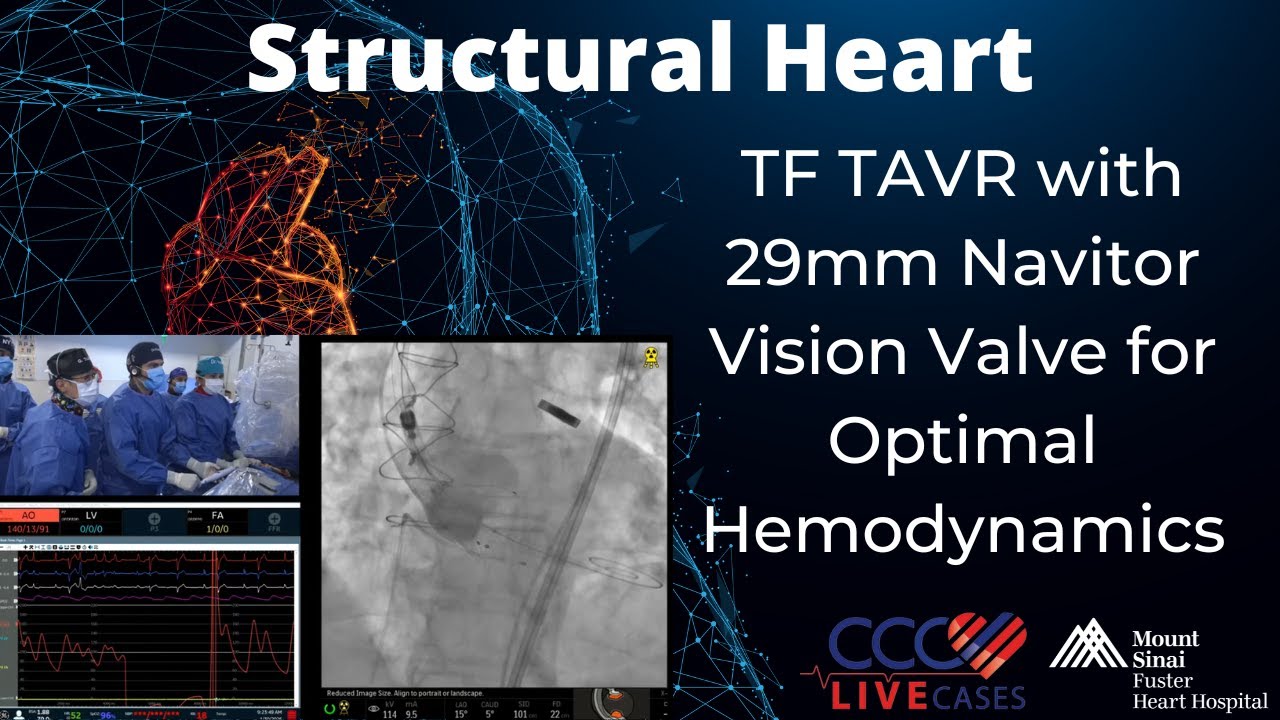TF TAVR with 29mm Navitor Vision Valve for Optimal Hemodynamics