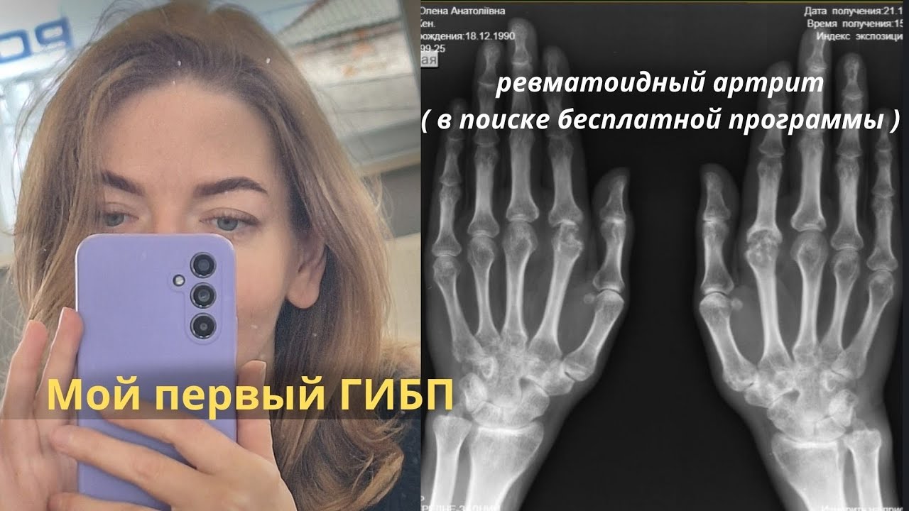 Ревматоидный артрит. Метотрексат + Хайримоз. 