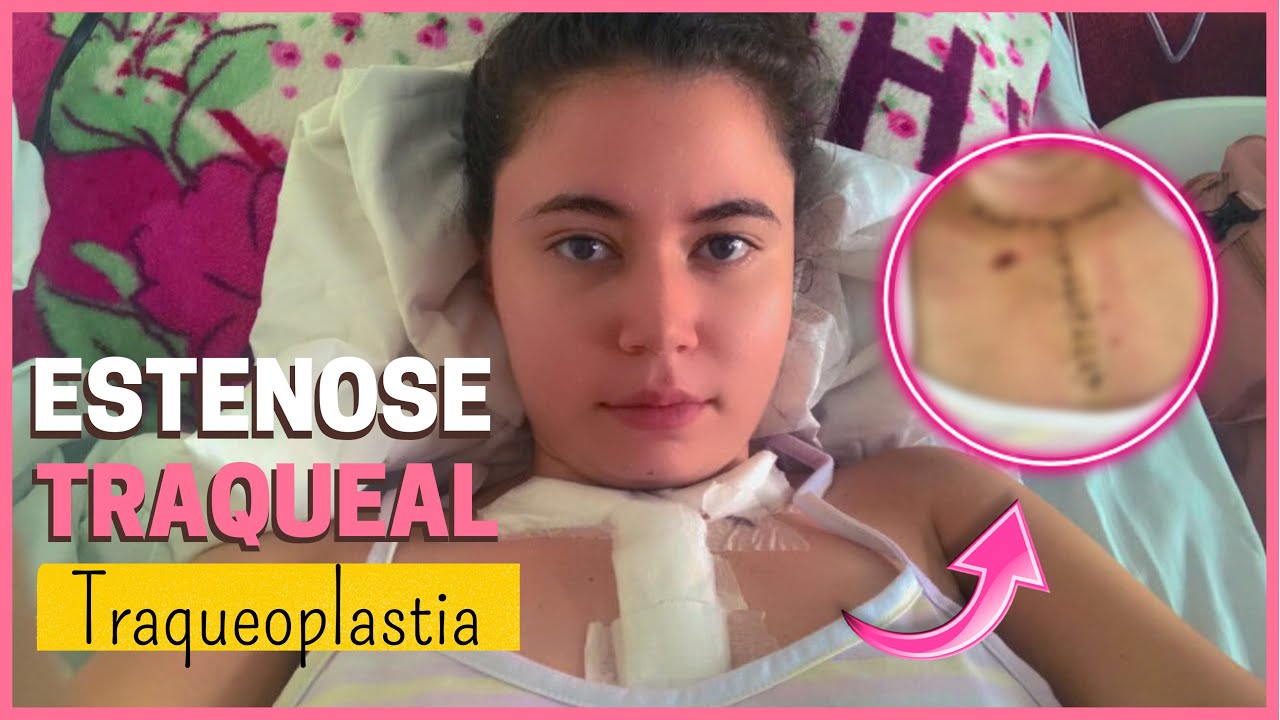 ⚜️ ESTENOSE TRAQUEAL: [Fiz a traqueoplastia]