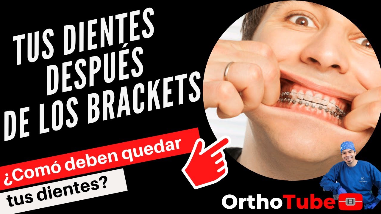 ✨CÓMO DEBEN QUEDAR LOS DIENTES DESPUÉS DE USAR BRACKETS✨ ¡ASÍ DEBE QUEDAR TU MORDIDA EN 2022!
