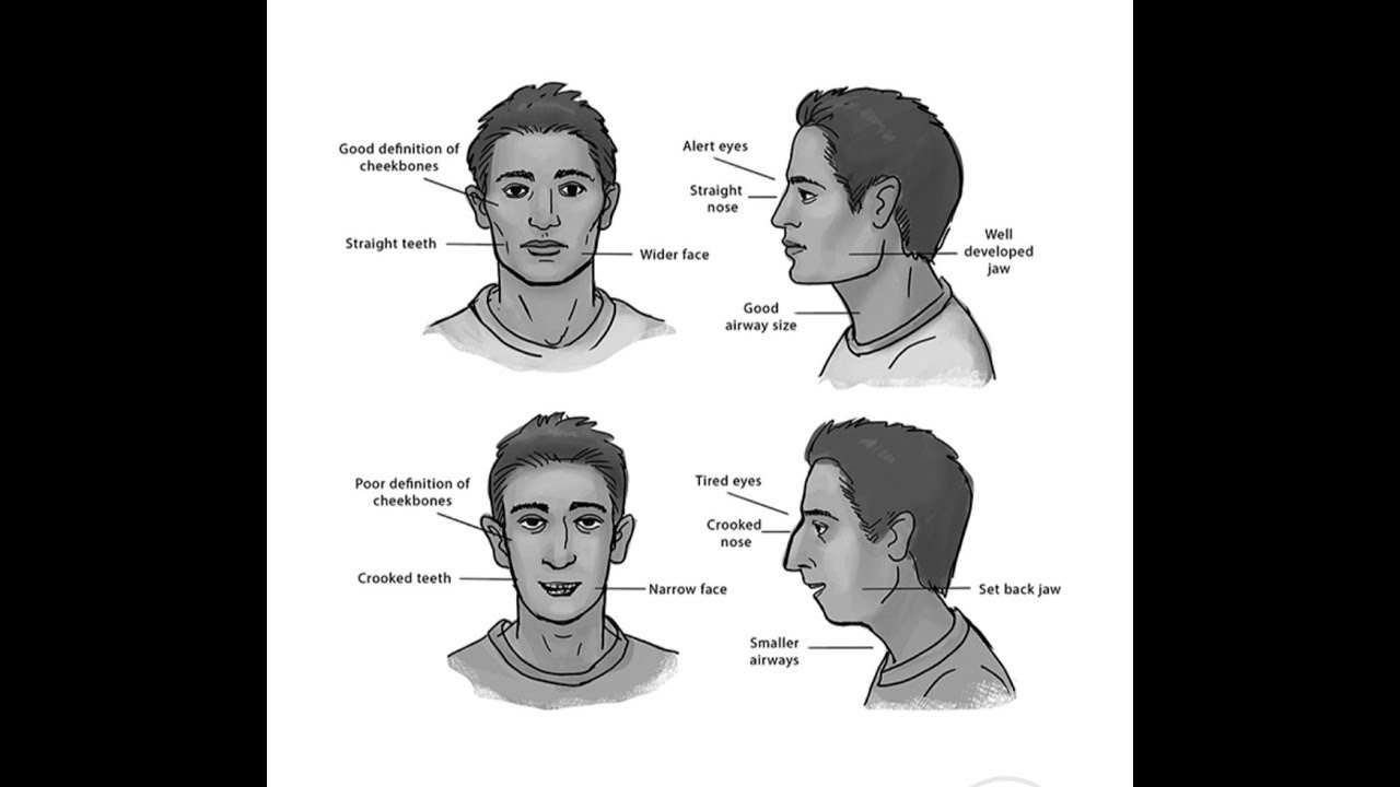 Face growth, Tongue restriction, and Improved Sleep!