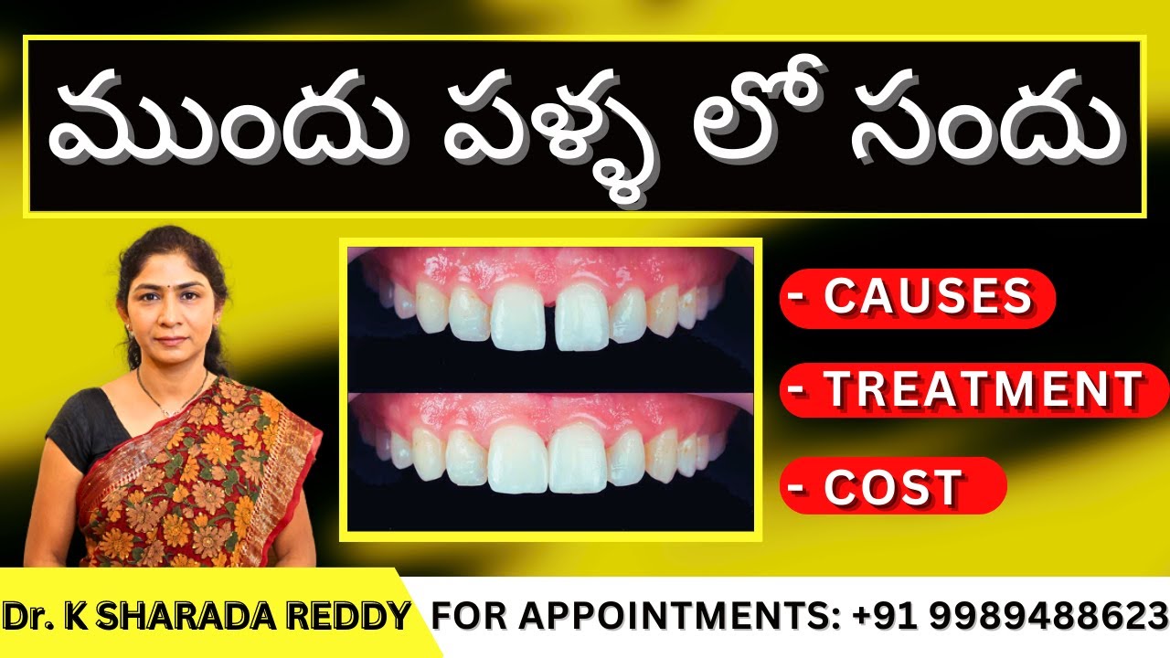 పళ్ళ మధ్యలో సందులు || How to Fill the Gaps Between Teeth? || Midline Diastema || Dr. K Sharada Reddy