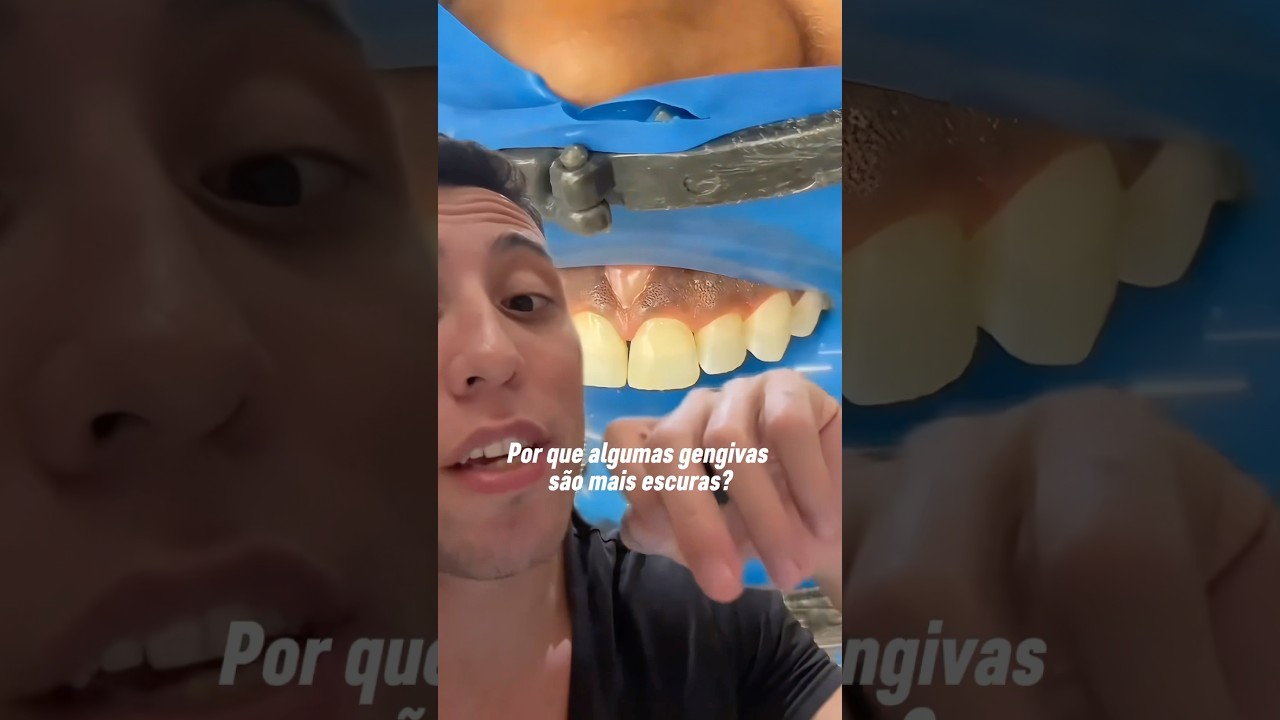 E essa gengiva negra a&iacute;? #dentista #odontologia